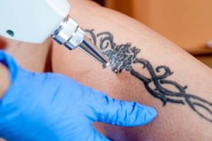 Get Your Tattoo Removed if You Do Not Like It Anymore