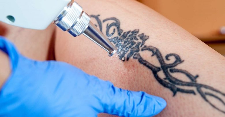 Get Your Tattoo Removed if You Do Not Like It Anymore