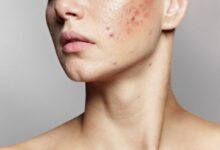 acne facial treatment in Singapore.