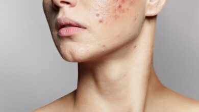 acne facial treatment in Singapore.