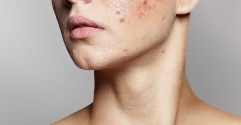 acne facial treatment in Singapore.